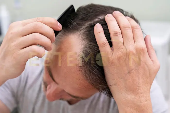Diffuse Thinning Treatments and Prevention Tips Explained