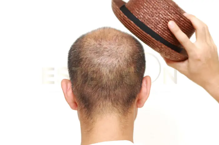 Do Hats Cause Hair Loss The Truth