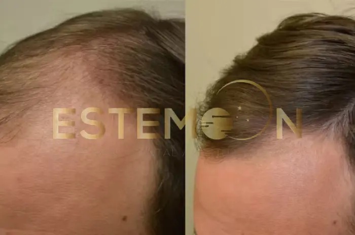 Finasteride Before and After Treatment