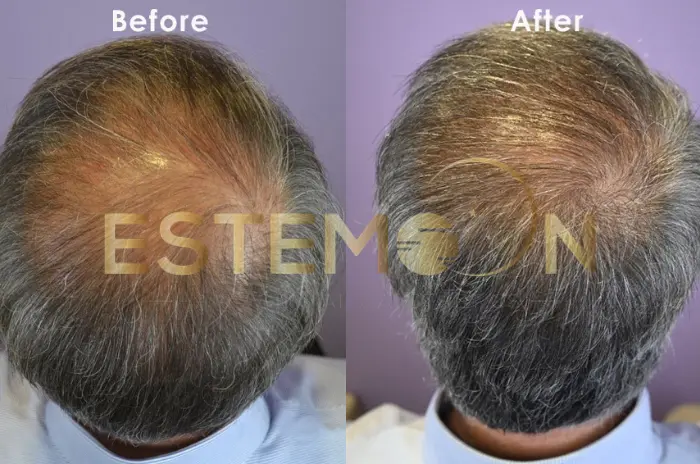 Finasteride Before and After Treatment Results