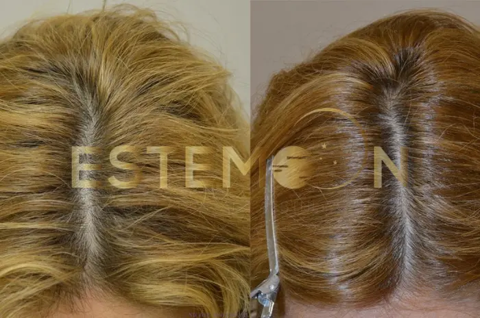 Finasteride Treatment