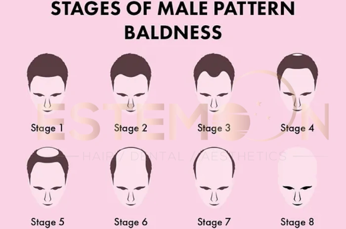 Male pattern baldness