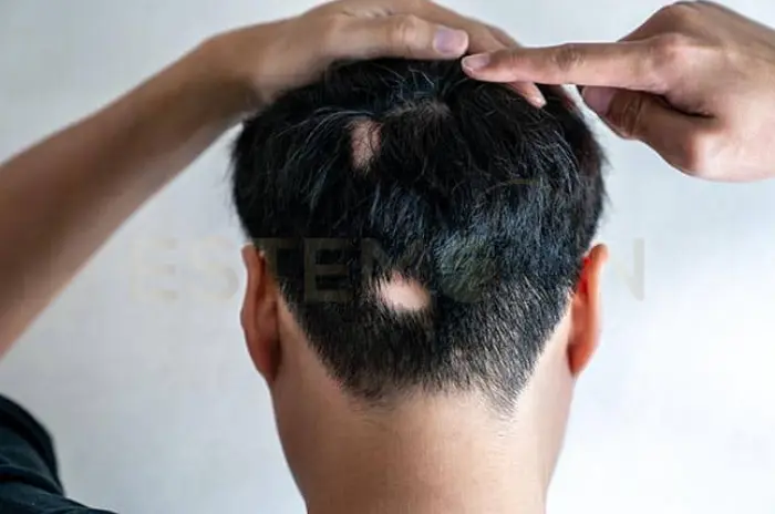 Ringworm of the hair symptoms and treatment