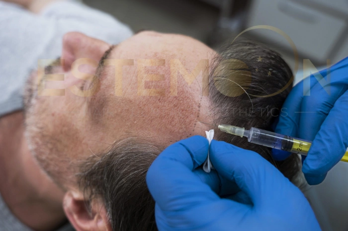 Treating baldness in men