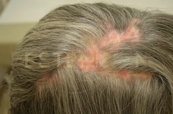 Understanding Scarring Alopecia Diagnosis