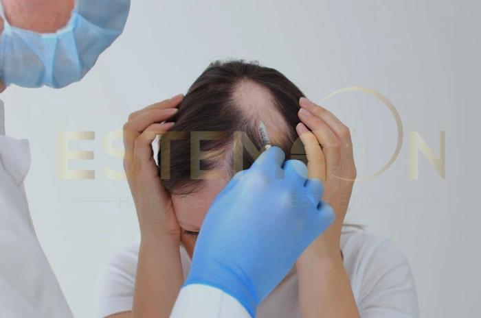 autoimmune hair loss symptoms
