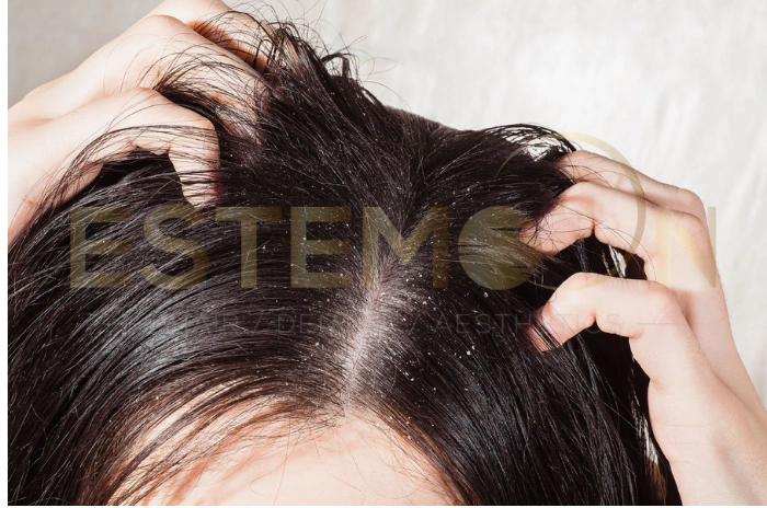 dry scalp treatment