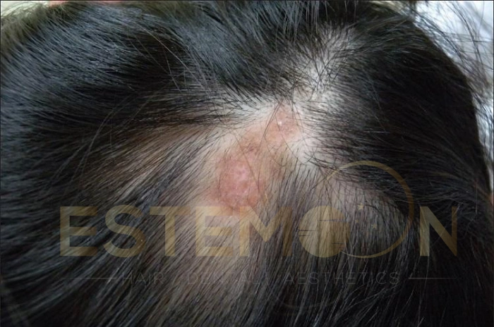 lupus hair loss