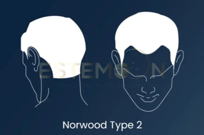 Norwood 2 guide