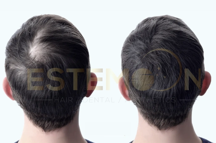 Norwood 3 hair transplant