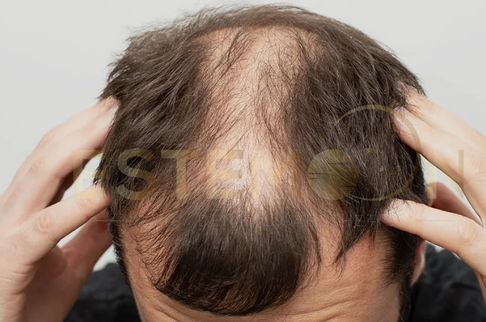 Stage 3 baldness