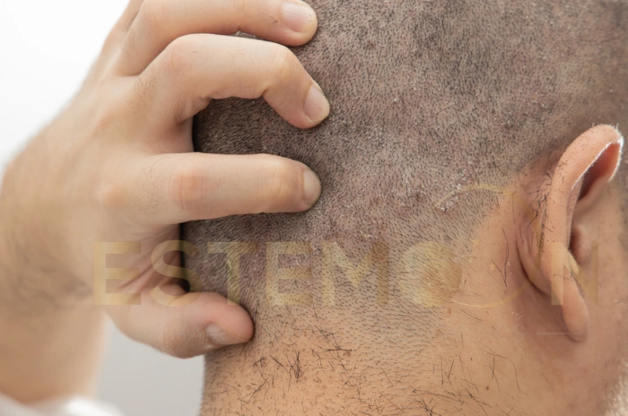bumps on scalp