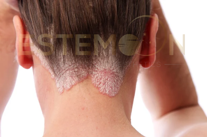 scalp eczema