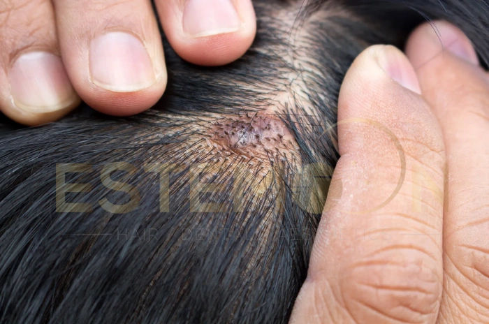 scalp eczema
